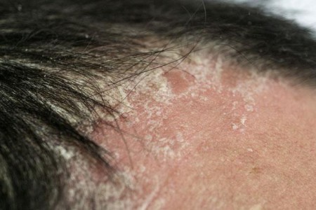 Scalp Psoriasis