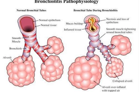Bronchiolitis