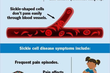 Sickle Cell Disease
