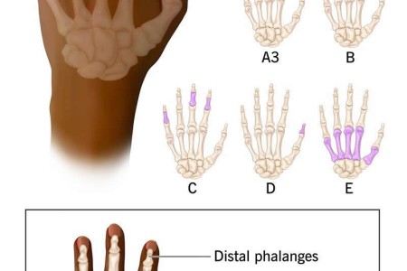 Brachydactyly