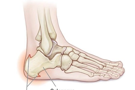 Bone Spur (Osteophyte)