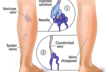 Sclerotherapy
