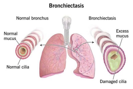 Bronchiectasis