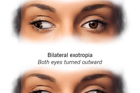 Exotropia