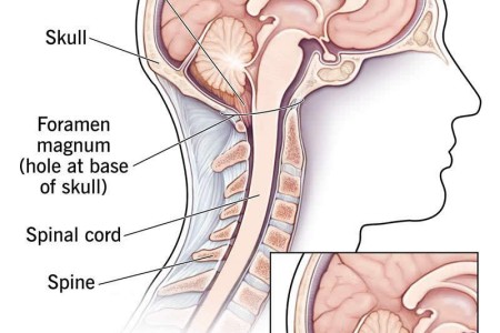 Chiari Malformation