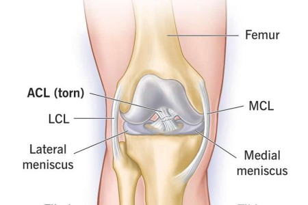 ACL Tear