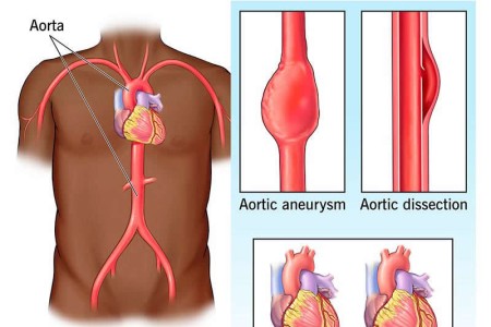 Marfan Syndrome