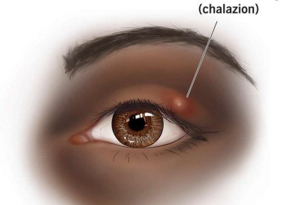 Chalazion