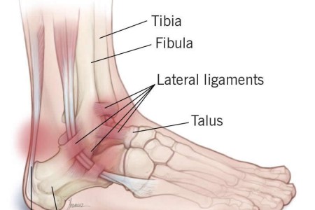Ankle Pain