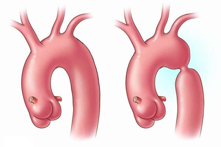 Coarctation of the Aorta
