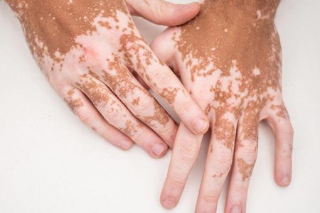 Vitiligo