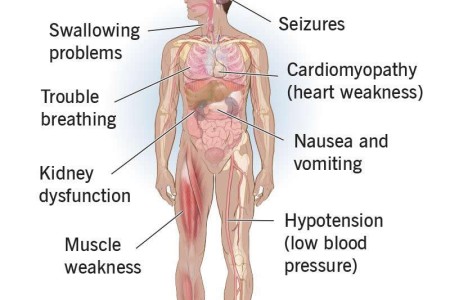 Refeeding Syndrome