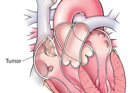 Heart Cancer