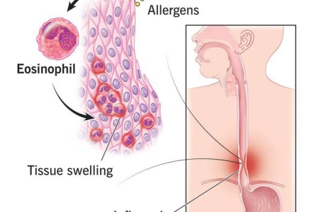 Eosinophilic Esophagitis
