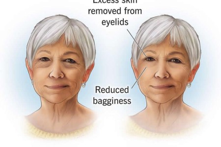 Eyelid Surgery (Blepharoplasty)
