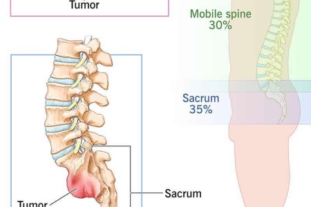Chordoma