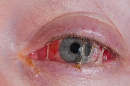 Eye Infection