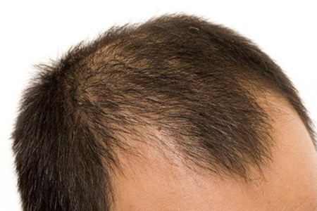 Male Pattern Baldness (Androgenic Alopecia)