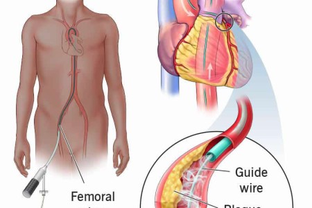 Angiogram