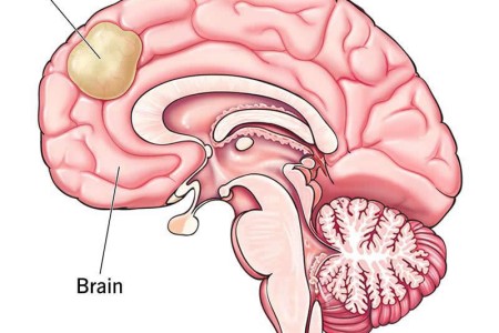 Glioblastoma (GBM)