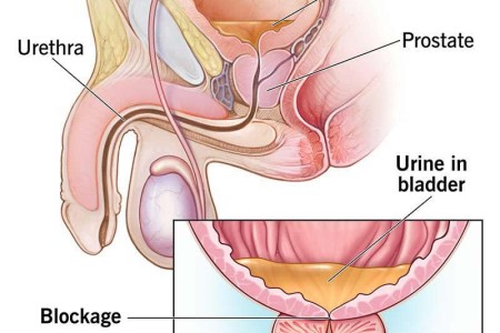 Urinary Retention