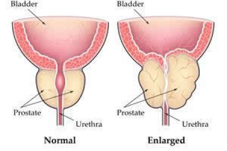 Holmium Laser Enucleation of the Prostate (HoLEP)