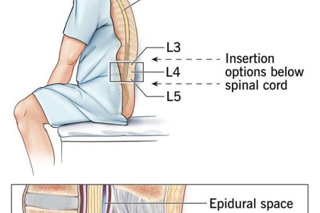 Epidural