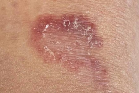 Granuloma Annulare