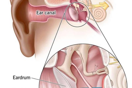 Tympanostomy (Ear Tubes)