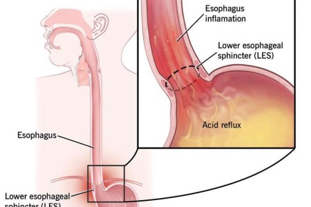 Heartburn