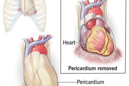 Pericardiectomy