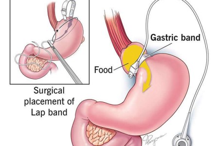 Gastric Band Surgery (Lap-Band)