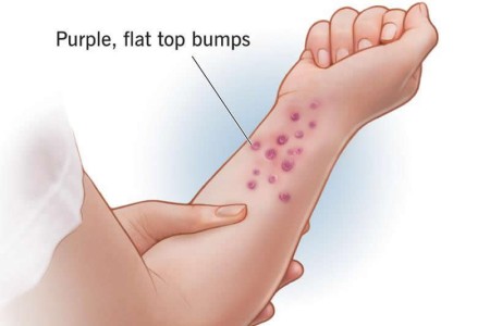 Lichen Planus