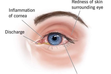 Keratitis