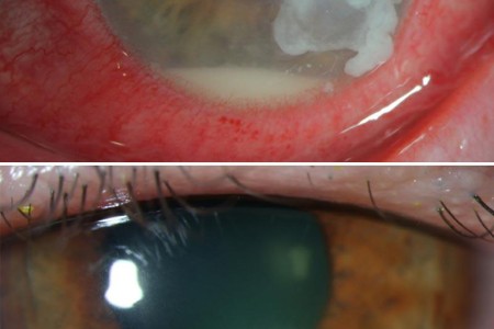Corneal Ulcer