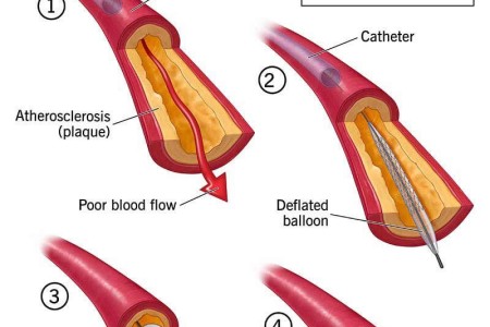Percutaneous Coronary Intervention