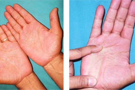 Erythromelalgia