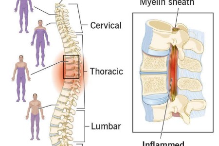 Transverse Myelitis (TM)