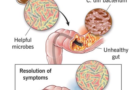 Fecal Transplant