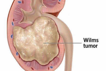 Wilms Tumor