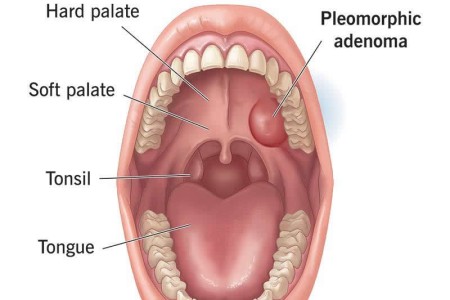 Pleomorphic Adenoma