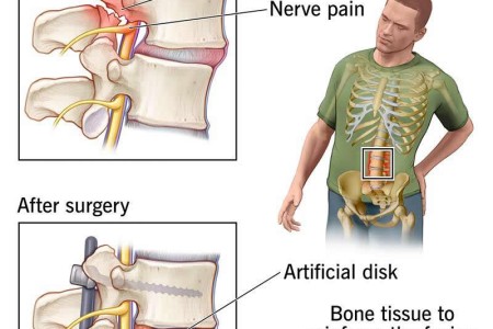 Spinal Fusion