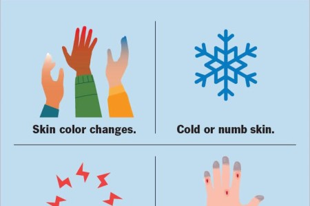 Raynaud’s Syndrome