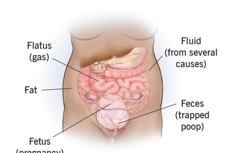 Abdominal Distension (Distended Abdomen)
