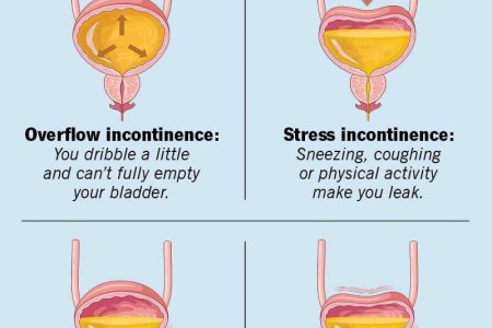 Urinary Incontinence