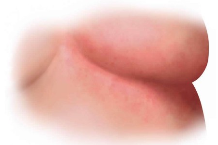 Yeast Infection Under Breast