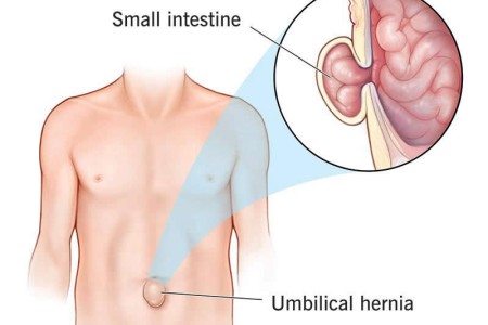 Umbilical Hernia
