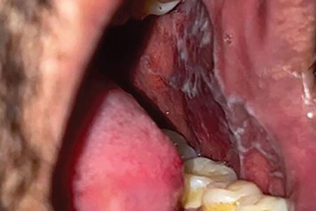 Oral Lichen Planus