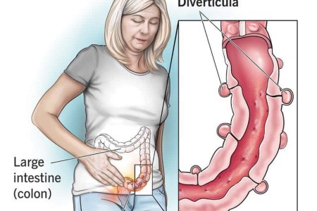 Diverticulosis