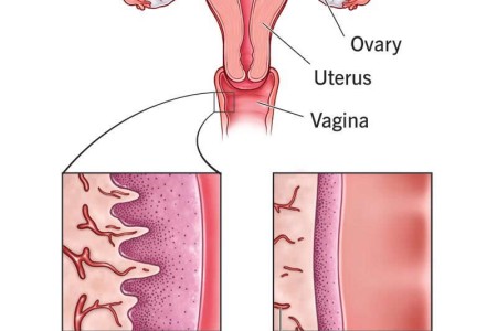 Vaginal Atrophy